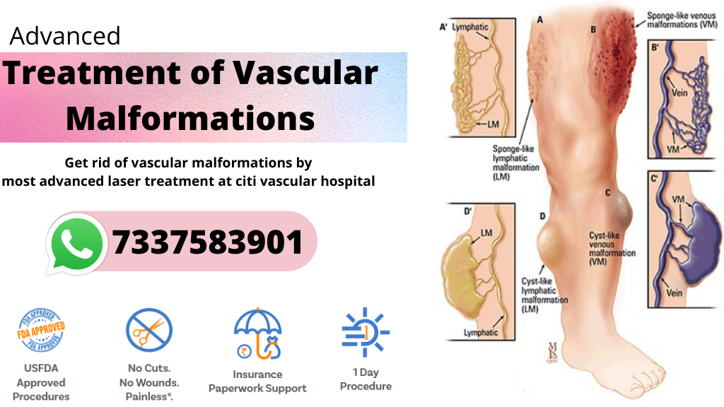 Vascular Malformation